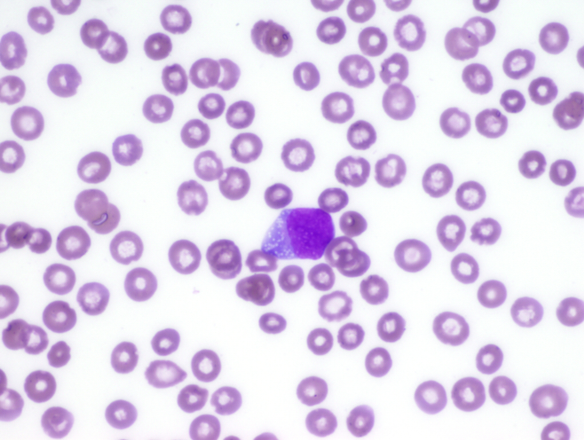 Blast in peripheral blood